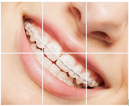 Ceramic Braces