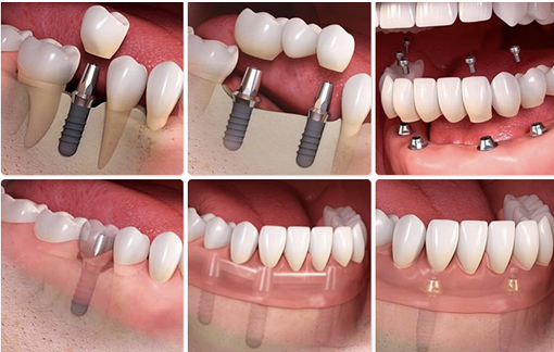 Dental Implants