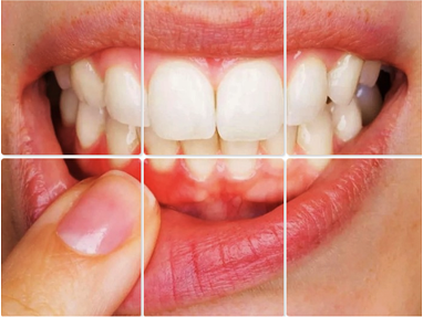 Gum Surgery & Periodontics