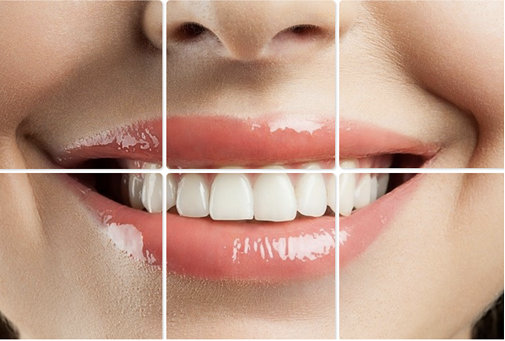 Porcelain & Composite Veneers