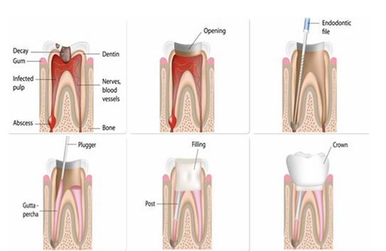 Root Canal Treatment (RCT)