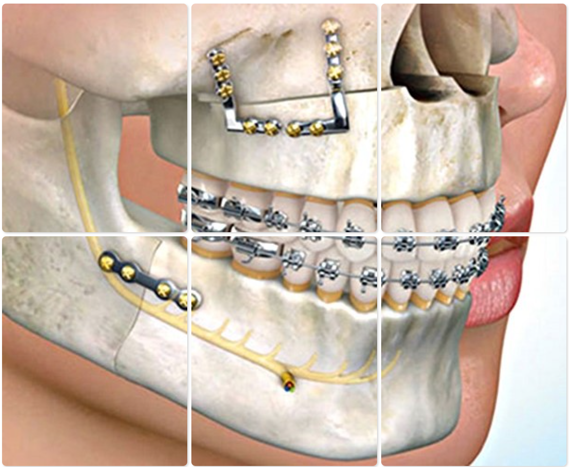 Surgical Orthodontics