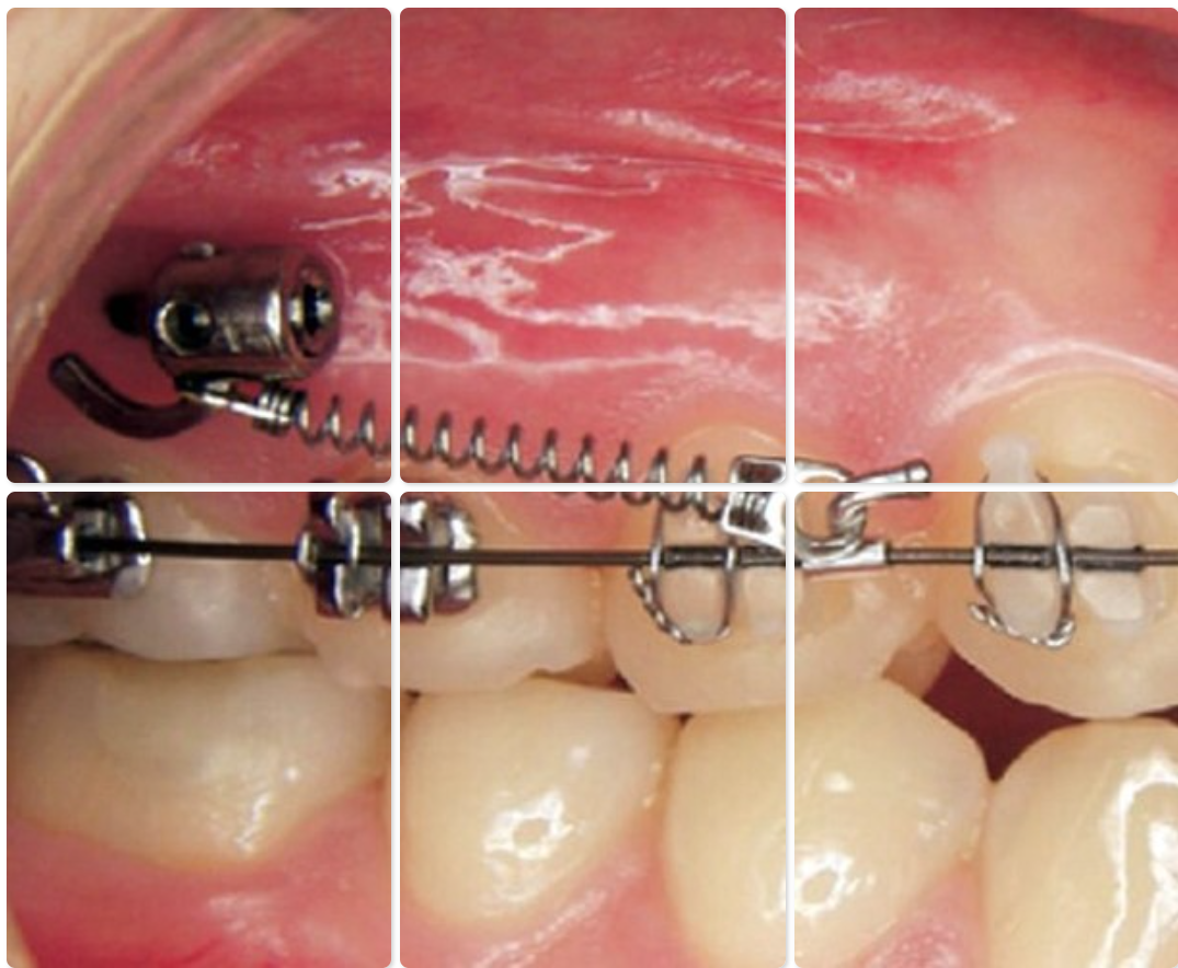 TADs / Micro Implants