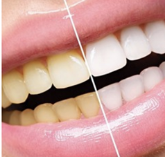 Teeth Whitening